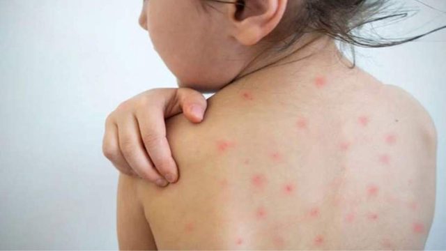 ২৪ ঘণ্টায় হামে আক্রান্ত ও উপসর্গে ১১ শিশুর মৃত্যু, বাড়ছে উদ্বেগ